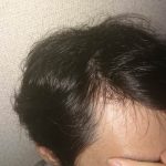 【悲報】ワイ30歳、完全にハゲスイッチON状態になる(画像あり) 【悲報】ワイ30歳、完全にハゲスイッチON状態になる(画像あり)