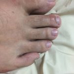 【画像】俺の足の小指の向きが変なんだが同じ向きの奴いる? 【画像】俺の足の小指の向きが変なんだが同じ向きの奴いる?